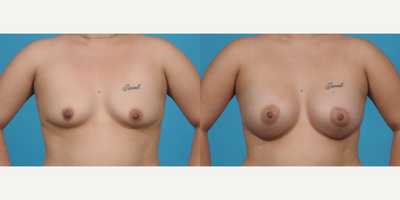 Case 8107 - 35-44 year old woman treated with Breast Augmentation, Inspira Breast Implants, Natrelle Breast Implants, Breast Implants