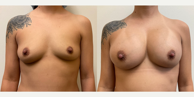 Case 8109 - Woman treated with Breast Augmentation, Breast Implants