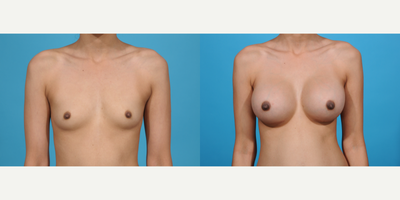 Case 8111 - 18-24 year old woman treated with Breast Augmentation, Breast Implants, Inspira Breast Implants, Natrelle Breast Implants