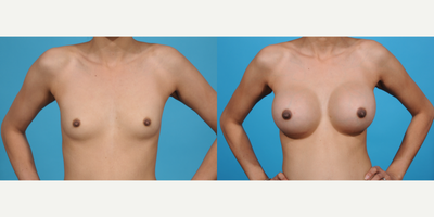 Case 8112 - 18-24 year old woman treated with Breast Augmentation, Breast Implants, Inspira Breast Implants, Natrelle Breast Implants