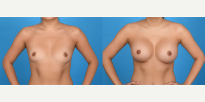 Case 8113 - 25-34 year old woman treated with Breast Augmentation, Breast Implants, Inspira Breast Implants, Natrelle Breast Implants