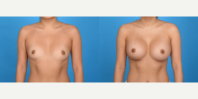 Case 8114 - 25-34 year old woman treated with Breast Augmentation, Breast Implants, Inspira Breast Implants, Natrelle Breast Implants