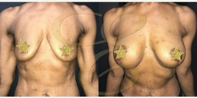 Case 8115 - Woman treated with Breast Augmentation, Breast Implants