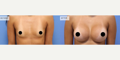 Case 8116 - Woman treated with Breast Augmentation, Breast Implants