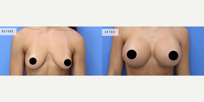 Case 8117 - Woman treated with Breast Augmentation, Breast Implants