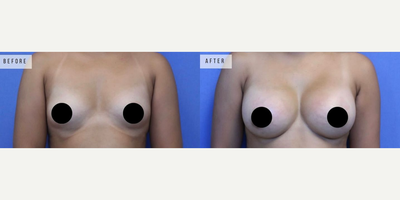 Case 8119 - Woman treated with Breast Augmentation, Breast Implants