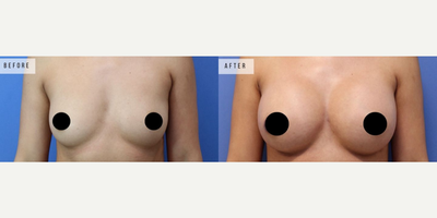 Case 8120 - Woman treated with Breast Augmentation, Breast Implants