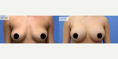 Case 8121 - Woman treated with Breast Augmentation, Breast Implants