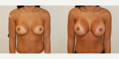 Case 8123 - Woman treated with Breast Implants