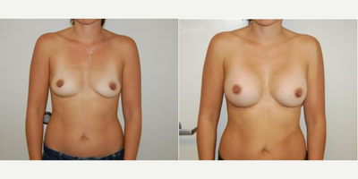 Case 8124 - Woman treated with Breast Implants