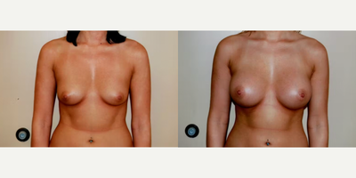 Case 8125 - Woman treated with Breast Implants