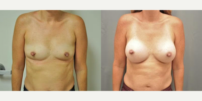 Case 8126 - Woman treated with Breast Implants