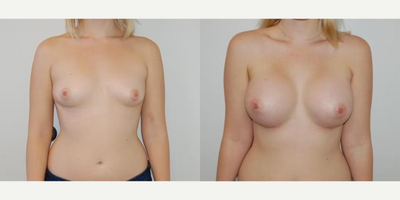 Case 8127 - Woman treated with Breast Implants