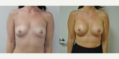 Case 8128 - Woman treated with Breast Implants