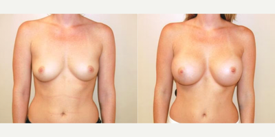 Case 8129 - Woman treated with Breast Implants