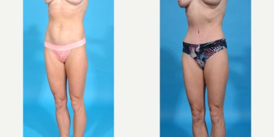 Case 813 - 45-54 year old woman treated with Abdominal Etching, Tummy Tuck, Mini Tummy Tuck, Drainless Tummy Tuck, Liposuction, Vaser Lipos