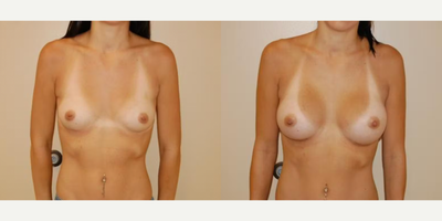 Case 8130 - Woman treated with Breast Implants