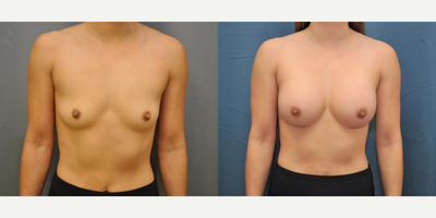 Case 8131 - Woman treated with Breast Implants