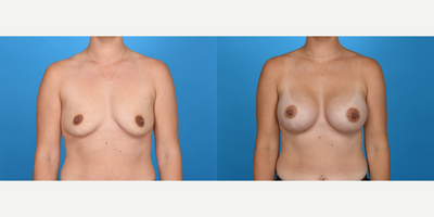 Case 8133 - 35-44 year old woman treated with Breast Augmentation, Breast Implants, Inspira Breast Implants, Natrelle Breast Implants, Mento