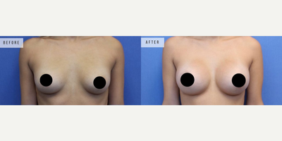 Case 8142 - Woman treated with Breast Augmentation, Breast Implants