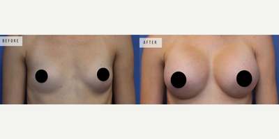Case 8143 - Woman treated with Breast Augmentation, Breast Implants