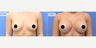 Case 8144 - Woman treated with Breast Augmentation, Breast Implants