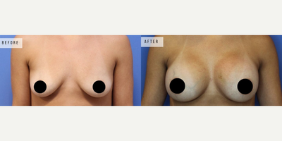 Case 8145 - Woman treated with Breast Augmentation, Breast Implants