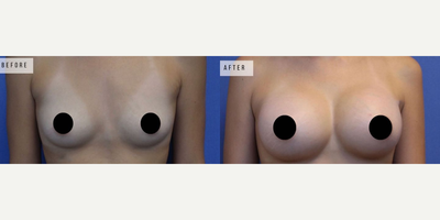 Case 8146 - Woman treated with Breast Augmentation, Breast Implants