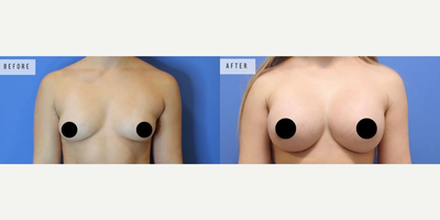 Case 8147 - Woman treated with Breast Augmentation, Breast Implants