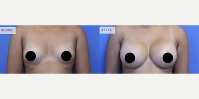 Case 8148 - Woman treated with Breast Augmentation, Breast Implants