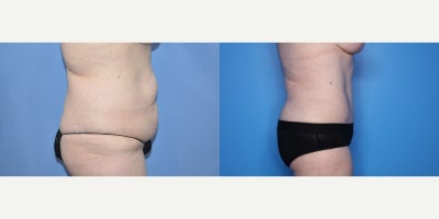 Case 815 - 35-44 year old woman treated with Tummy Tuck