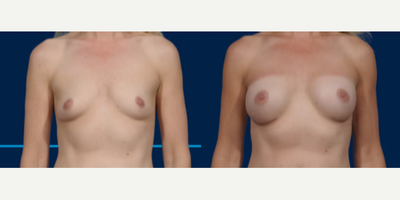 Case 8150 - Woman treated with Breast Implants