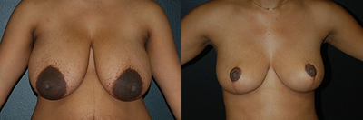 Case: 8152 - before and after photo of Woman treated with Breast Lift, Breast Reduction by Robert L. Steely, MD, FACS