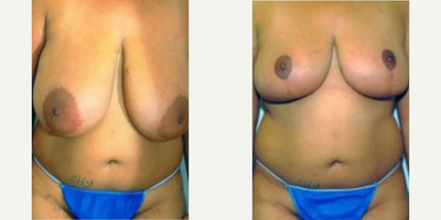 Case: 8155 - before and after photo of Woman treated with Breast Reduction by Harry T. Haramis, MD, FACS