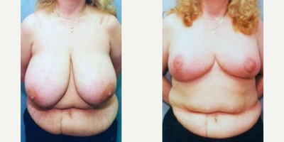 Case: 8156 - before and after photo of Woman treated with Breast Reduction by Harry T. Haramis, MD, FACS