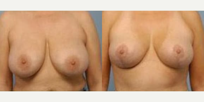 Case: 8157 - before and after photo of Woman treated with Breast Reduction by Harry T. Haramis, MD, FACS