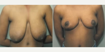 Case: 8158 - before and after photo of Woman treated with Breast Reduction by Harry T. Haramis, MD, FACS