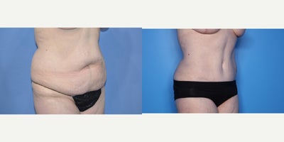 Case 816 - 35-44 year old woman treated with Tummy Tuck