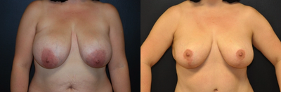 Case 8162 - Woman treated with Breast Lift, Breast Reduction