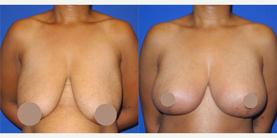Case 8168 - Woman treated with Breast Lift, Breast Reduction