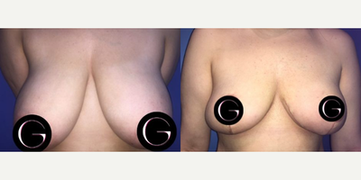Case 8172 - Woman treated with Breast Reduction