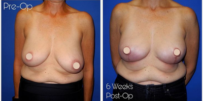 Case 8177 - Woman treated with Breast Reduction, Breast Lift