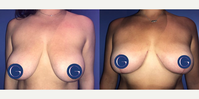 Case 8178 - Woman treated with Breast Reduction