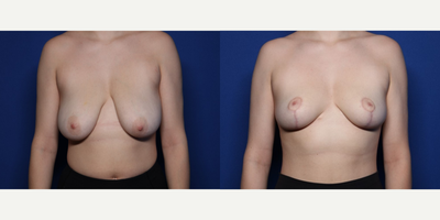Case 8179 - 18-24 year old woman treated with Breast Reduction