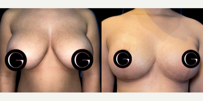 Case 8182 - Woman treated with Breast Lift, Breast Reduction