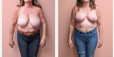 Case 8183 - 55-64 year old woman treated with Breast Lift, Breast Reduction