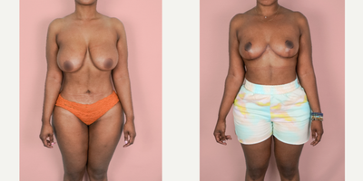 Case 8184 - 25-34 year old woman treated with Breast Reduction, Breast Lift