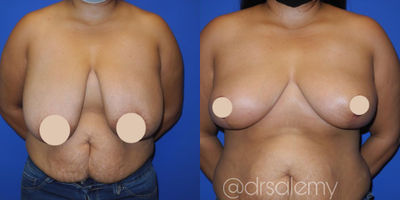 Case 8185 - 25-34 year old woman treated with Breast Reduction