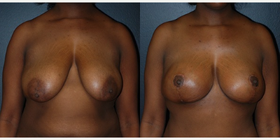 Case 8194 - Woman treated with Breast Reduction