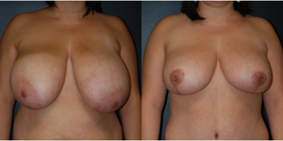 Case 8195 - 25-34 year old woman treated with Breast Reduction